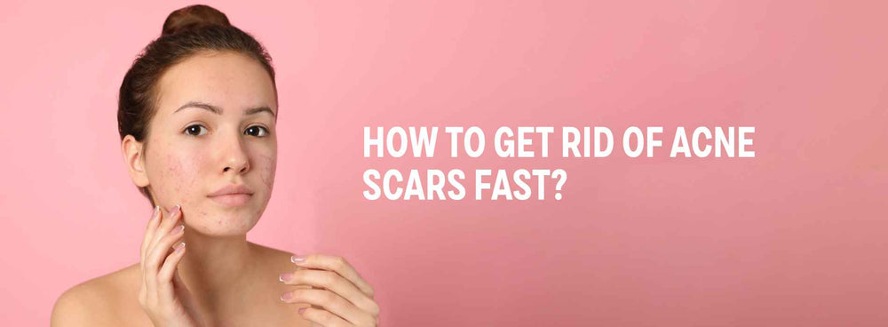 How To Get Rid Of Acne Scars Fast? Treatments & Home Remedies